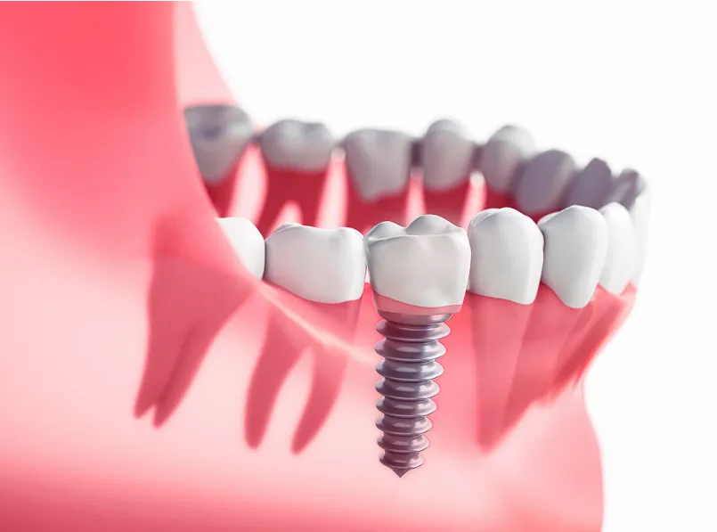 Read more about the article What are Dental Implants? Types of Dental Implants, Procedures, and Benefits