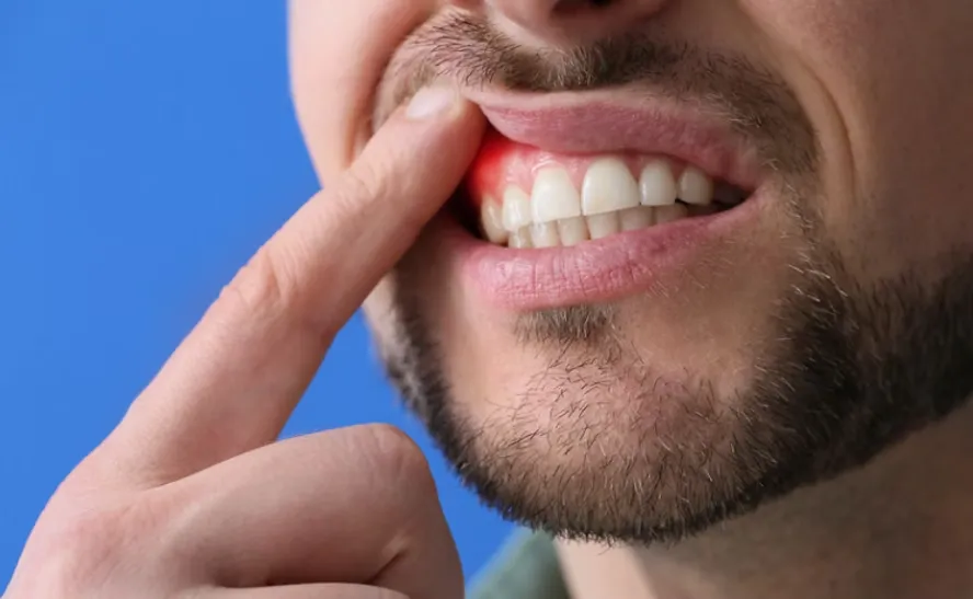 You are currently viewing Why Do My Gums Bleed? Top 5 Reasons and How to Prevent It