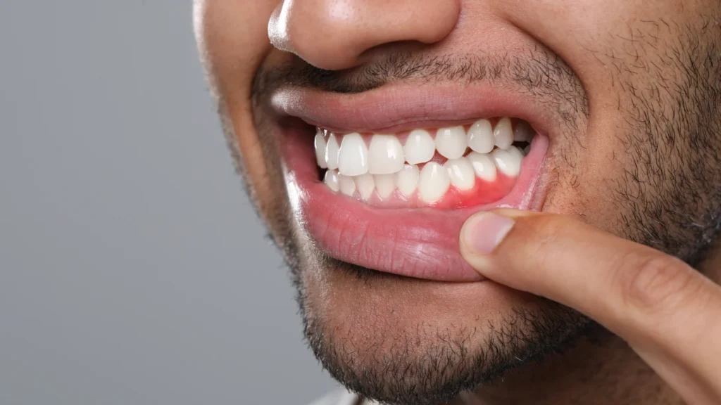 Close-up of a man pulling down his lower lip to show red, inflamed gums near the teeth, highlighting early signs of gum disease and the importance of gum health care.