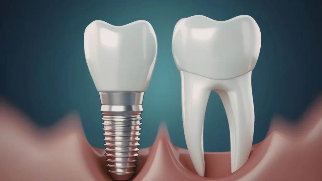 3D illustration of a Single Dental Implant in Kokapet, showing a titanium implant screw placed in the jawbone alongside a natural tooth for comparison, highlighting tooth replacement procedure and structure.