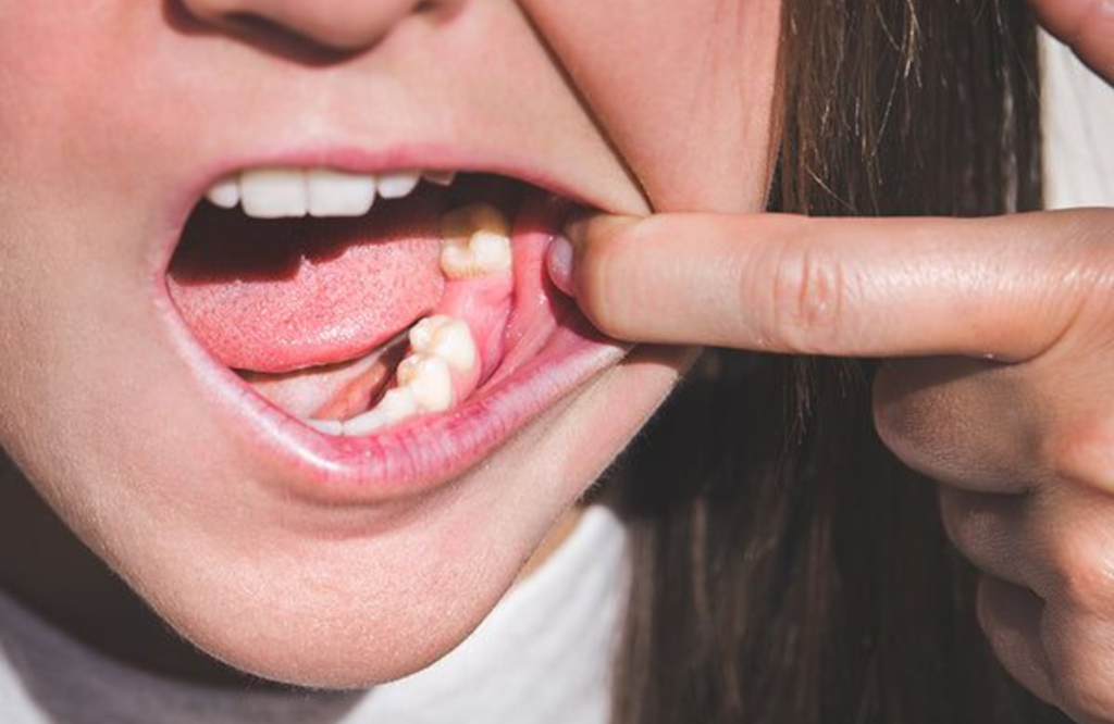 Person pointing at a painful sore or cavity inside the mouth, illustrating early warning signs of tooth decay and oral health issues.