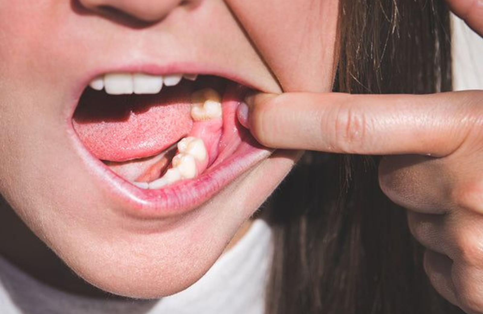 Person pointing at a painful sore or cavity inside the mouth, illustrating early warning signs of tooth decay and oral health issues.