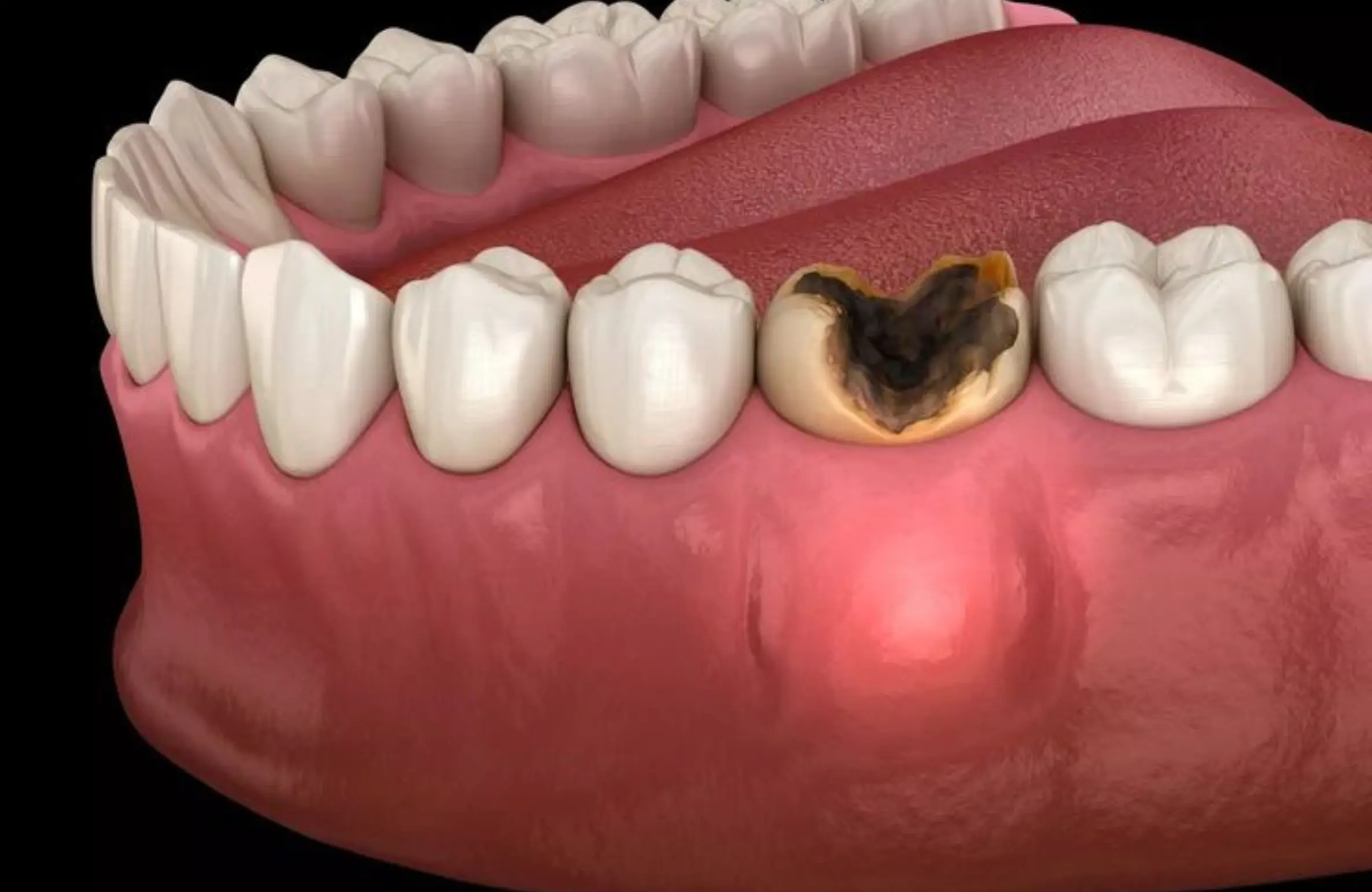 Dental cavity 3D showing tooth decay compared with healthy teeth