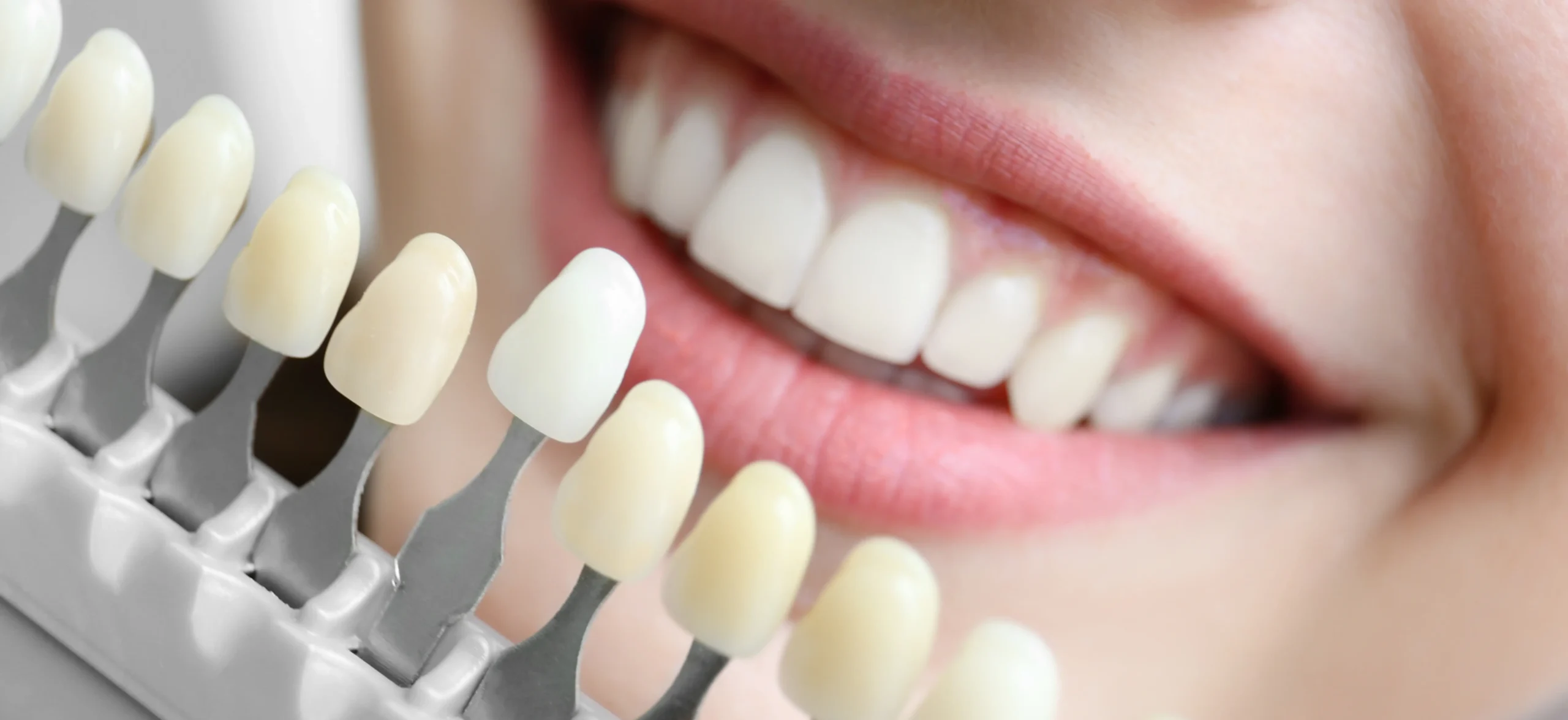      Teeth Whitening Options: Professional vs. Over-the-Counter