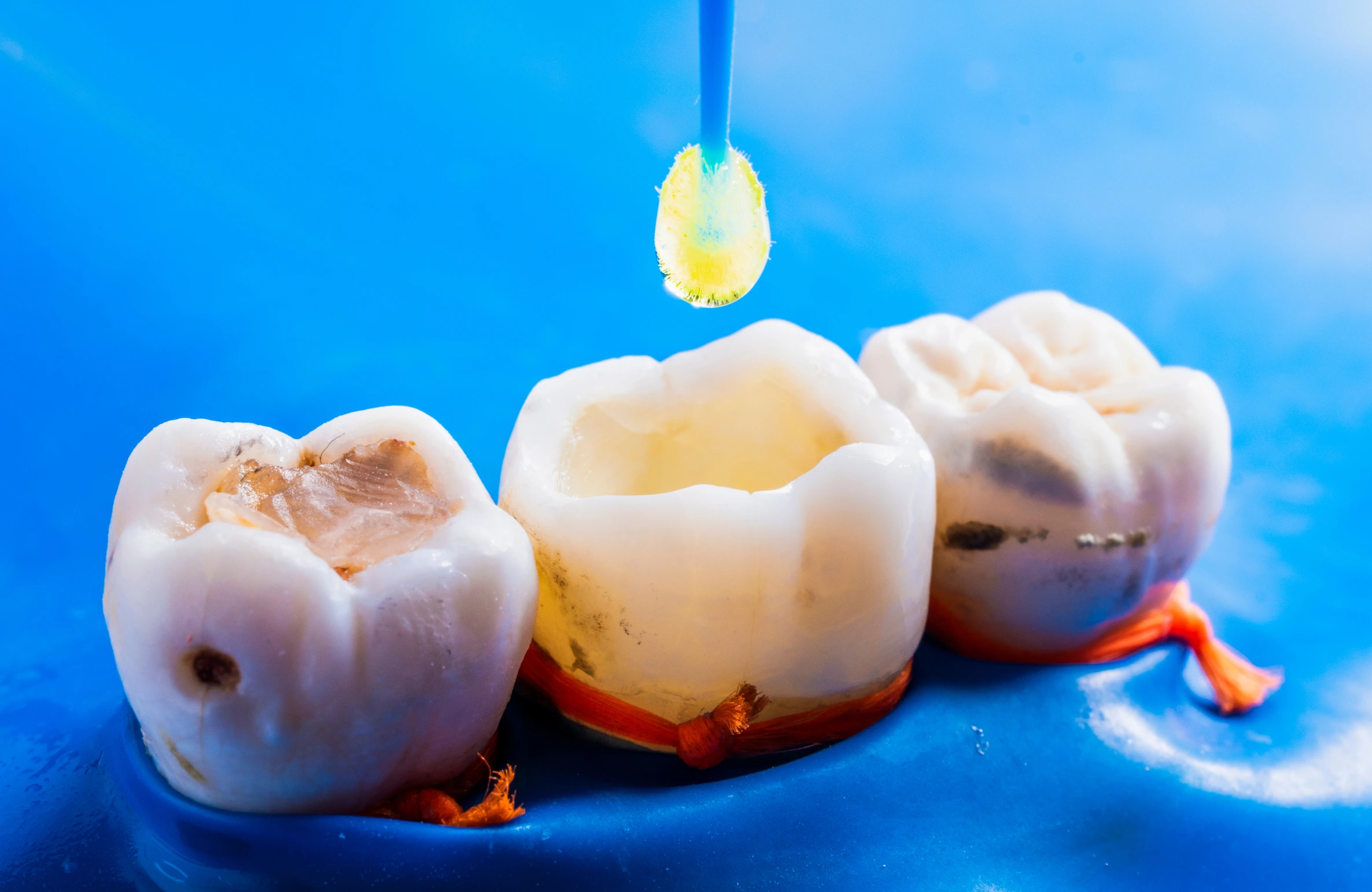 The Complete Guide to Dental Fillings: Types, Procedure, Cost, and Aftercare